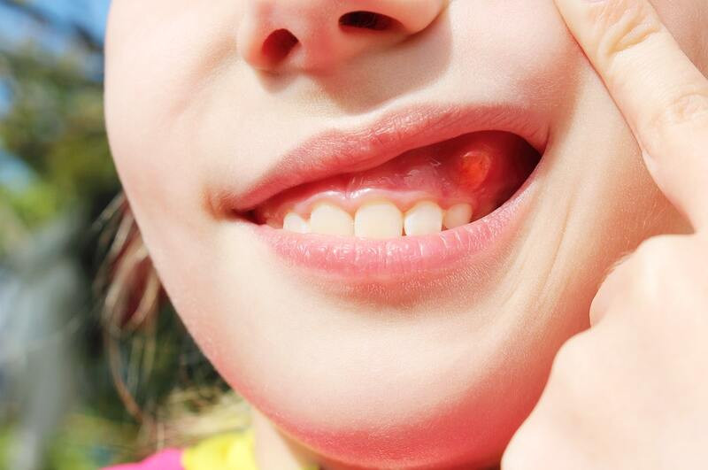 Răng mọc ngầm, một vấn đề không hề nhỏ trong lĩnh vực nha khoa, đang đặt ra một loạt các thách thức cho sức khỏe răng miệng và tạo ra nhiều phiền toái cho người bệnh. Tình trạng này không chỉ gây khó chịu mà còn tiềm ẩn rất nhiều nguy cơ nếu không được phát hiện và điều trị kịp thời.